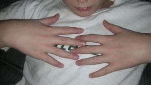 Swollen but half the size of yesterday